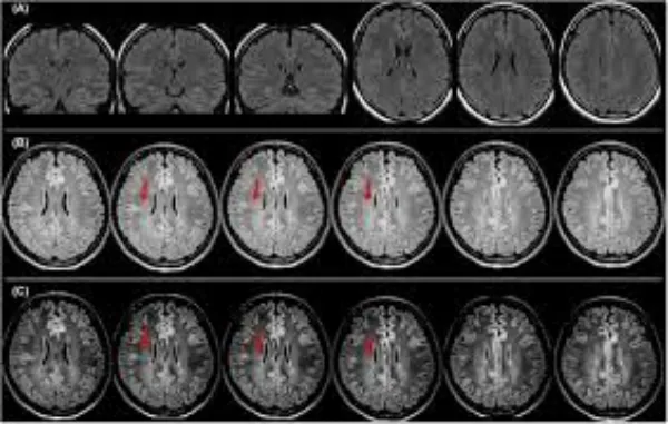 Neuroimaging in Epilepsy